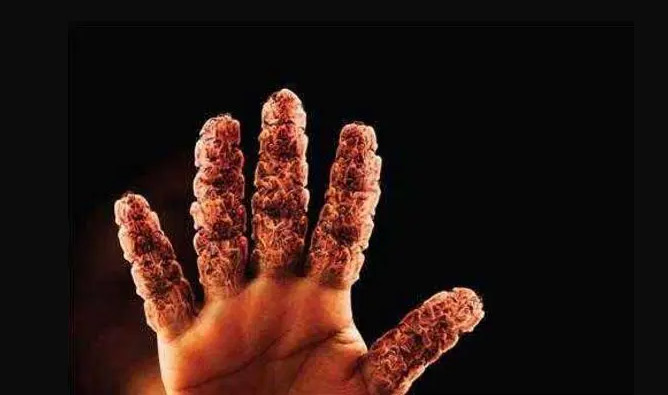 痛风病人的日常调理办法